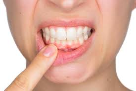 Home Remedies To Keep Teeth And Gums Healthy
