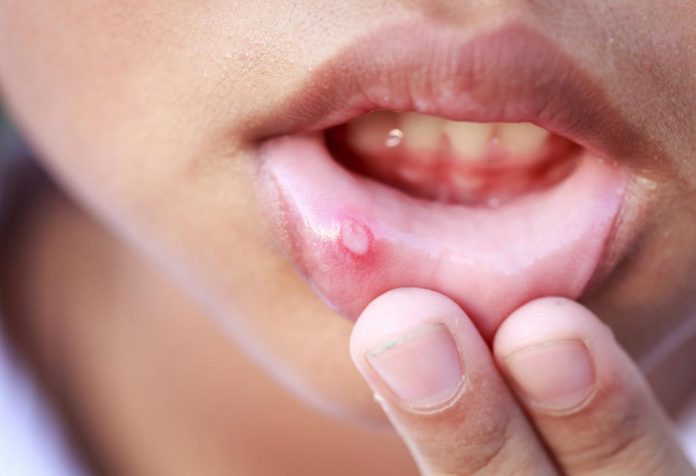 Treatment Of Mouth Ulcers