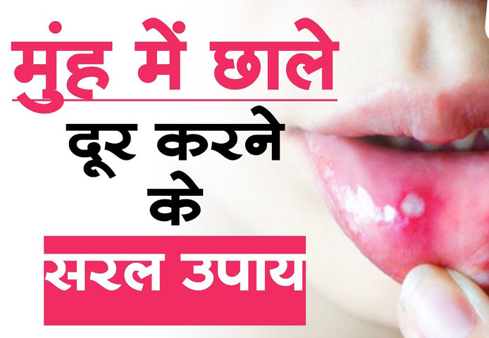 Remedies To Get Rid Of Mouth Ulcers