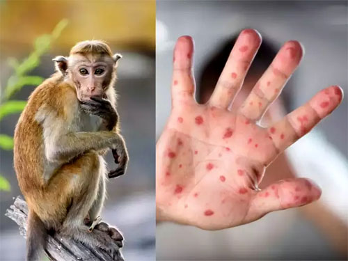 Monkeypox Reached Country From Abroad