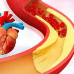 Reduce High Cholesterol