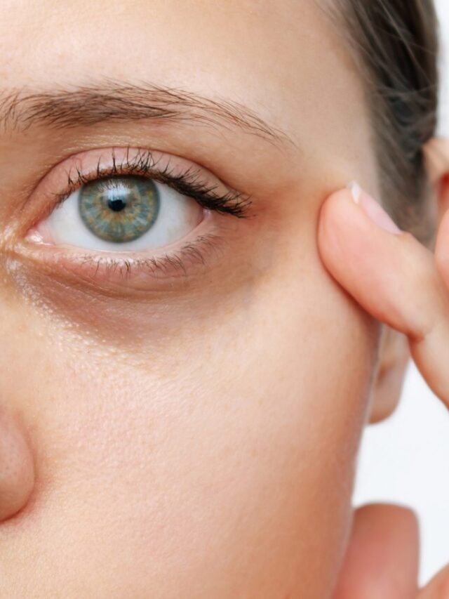 Dark Circles : आंखों के नीचे डार्क सर्कल्स से हैं परेशान? अपनाएं ये घरेलू उपाय