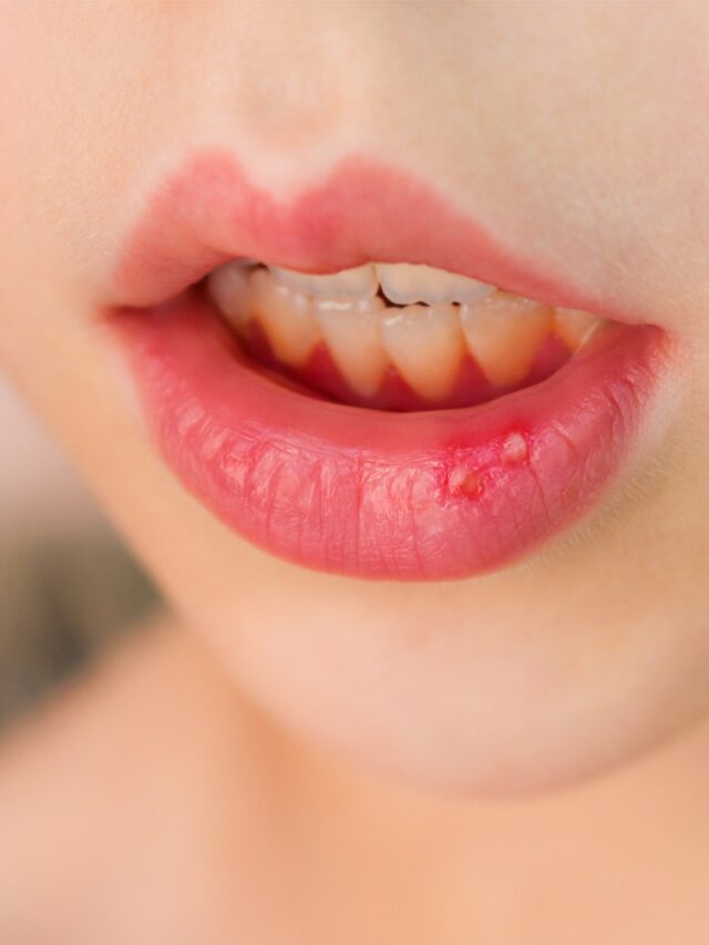 Mouth Ulcers: मुंह में बार-बार छाले क्यों पड़ते हैं? वजह जानकर आप भी रह जाएंगे हैरान