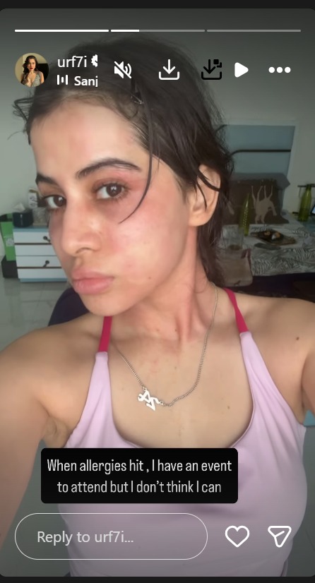 Urfi Javed के चेहरे पर छाई मुसीबत, एलर्जी से सूजा चेहरा, फैंस में बढ़ी चिंता