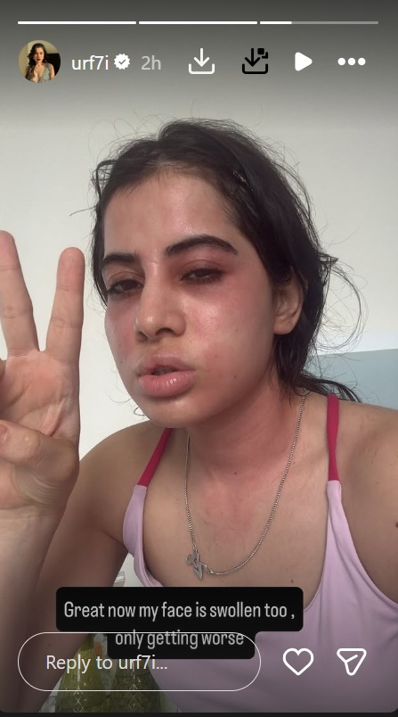 Urfi Javed के चेहरे पर छाई मुसीबत, एलर्जी से सूजा चेहरा, फैंस में बढ़ी चिंता