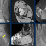 Bone Tumors