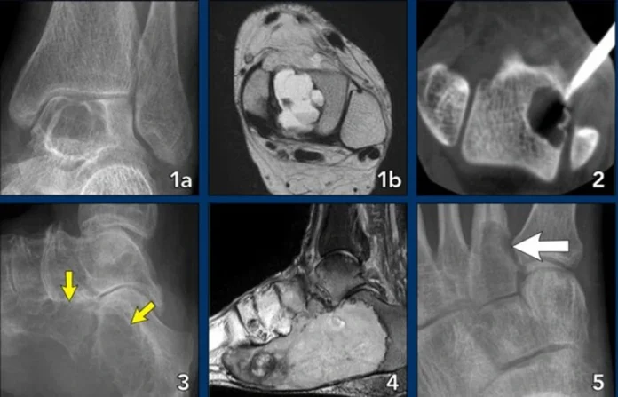 Bone Tumors